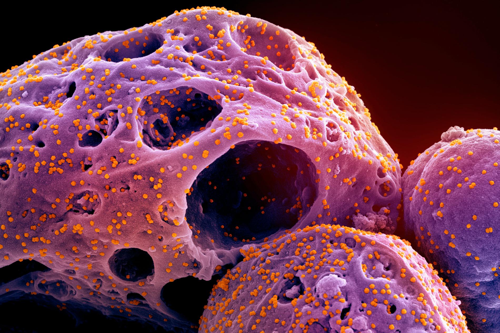 INFISERTE CELLER: Bildet viser kroppsceller i lilla. De gule prikkene er Omikron. Det nye coronaviruset Pirola er en variant av Omikron. 
