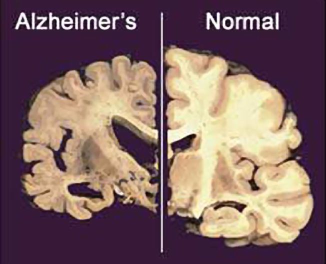 Forskjell På Alzheimer Og Demens