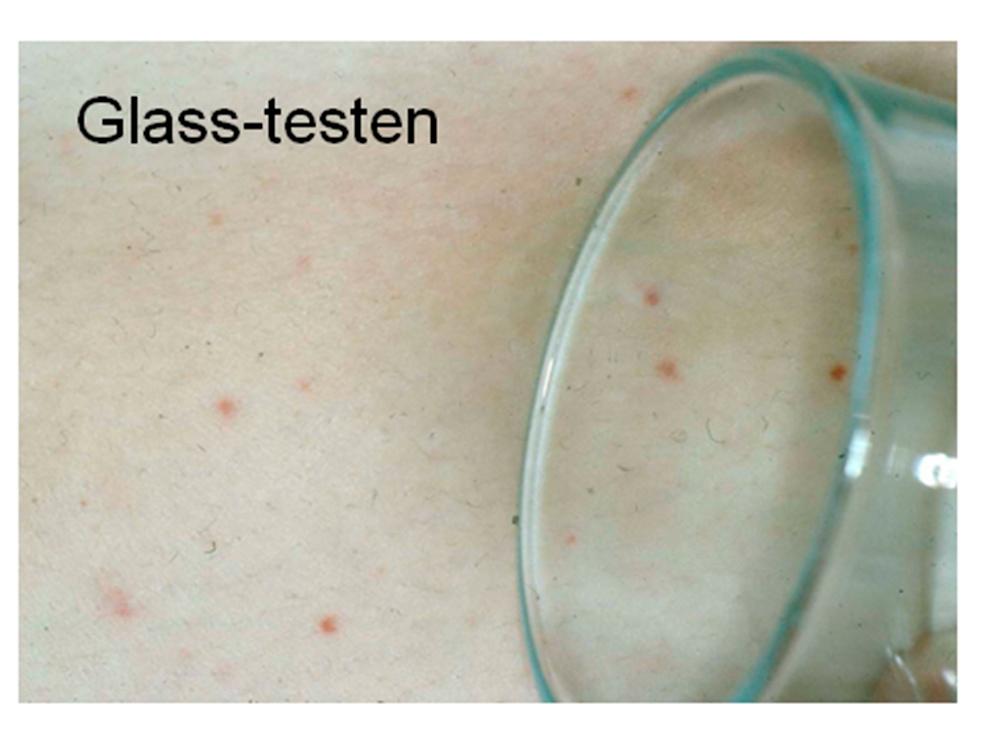 Mirror test: The picture shows what the early rash associated with meningitis looks like.  Even if you press the glass, the rash will not go away.